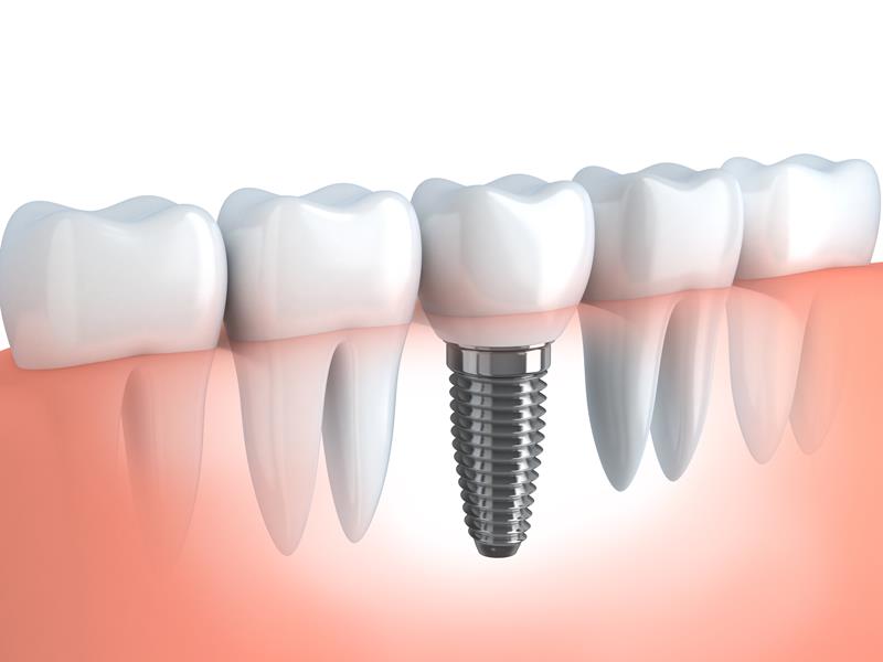 Dental Implants Palacios, TX