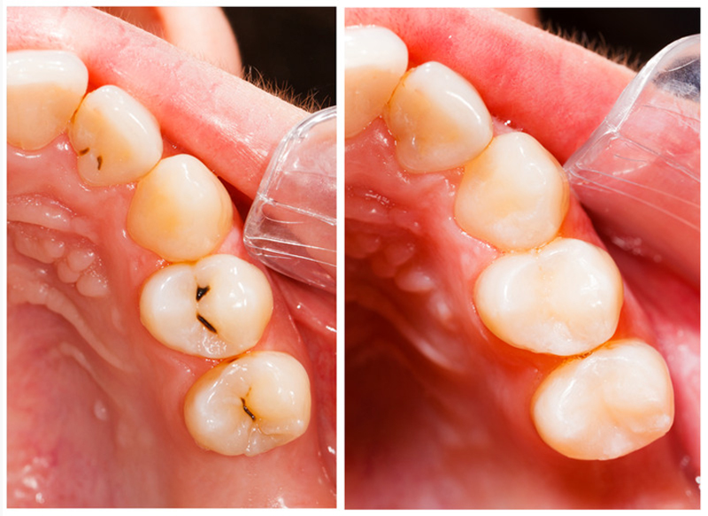 Fillings Palacios, TX