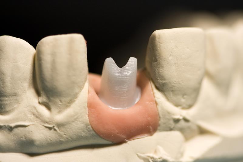 Implant Restoration Palacios, TX