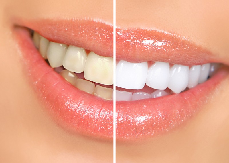Teeth Whitening Palacios, TX